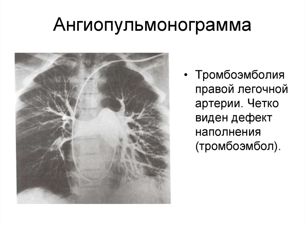 Что такое тромбоэмболия легочной артерии простыми. Кт Тэла ангиопульмонография. Селективная ангиопульмонография. Массивная Тэла рентген.