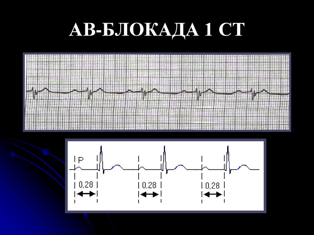 Ав блокада 1. Атриовентрикулярная блокада Мобиц 1 ЭКГ. Аб блокада 1 степени на ЭКГ. Av-блокада II–III ст. (. Атриовентрикулярная блокада 1 степени на ЭКГ.