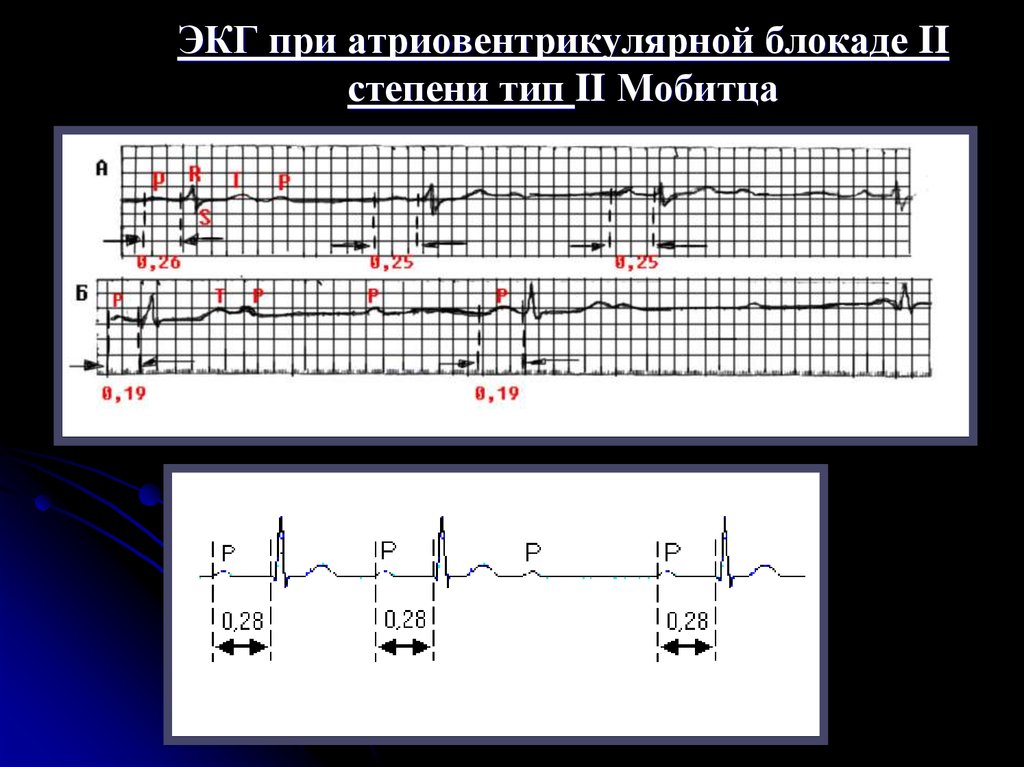 Атриовентрикулярная блокада признаки. ЭКГ при АВ блокаде 2 степени. Атриовентрикулярная блокада 2 степени на ЭКГ. АВ блокада 2 степени Мобитц 1 критерии. АВ блокада 3 степени на ЭКГ.