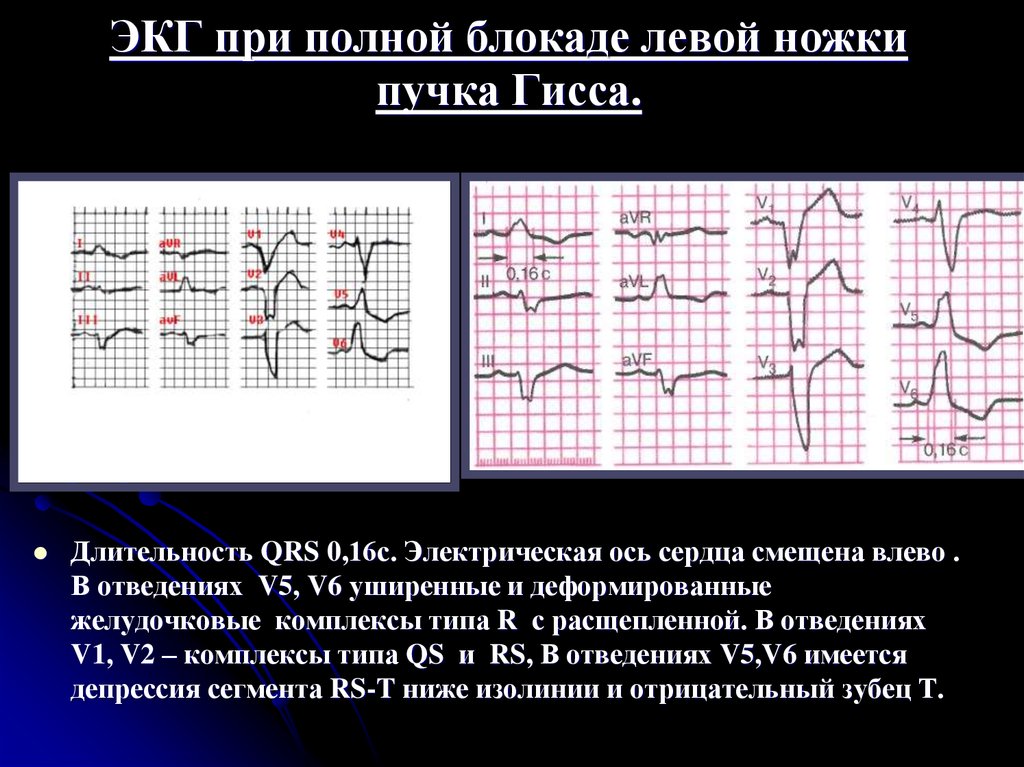 Неполная блокада гиса на экг. ЭКГ при полной блокаде пучка Гиса. ЭКГ при полной блокаде ножек пучка Гиса. Депрессия St при блокаде левой ножки пучка Гиса. Блокада ножек пучка Гиса на ЭКГ отведения.