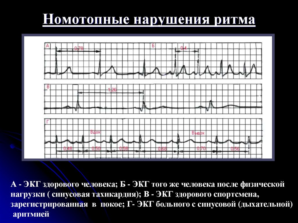 Как выглядит кардиограмма здорового человека фото и больного