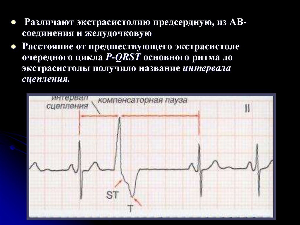 Экстрасистолы. Предсердная экстрасистолия и желудочковая экстрасистолия. Отличие желудочковой и предсердной экстрасистолы. Экстрасистола из АВ соединения. Экстрасистолия АВ соединения.