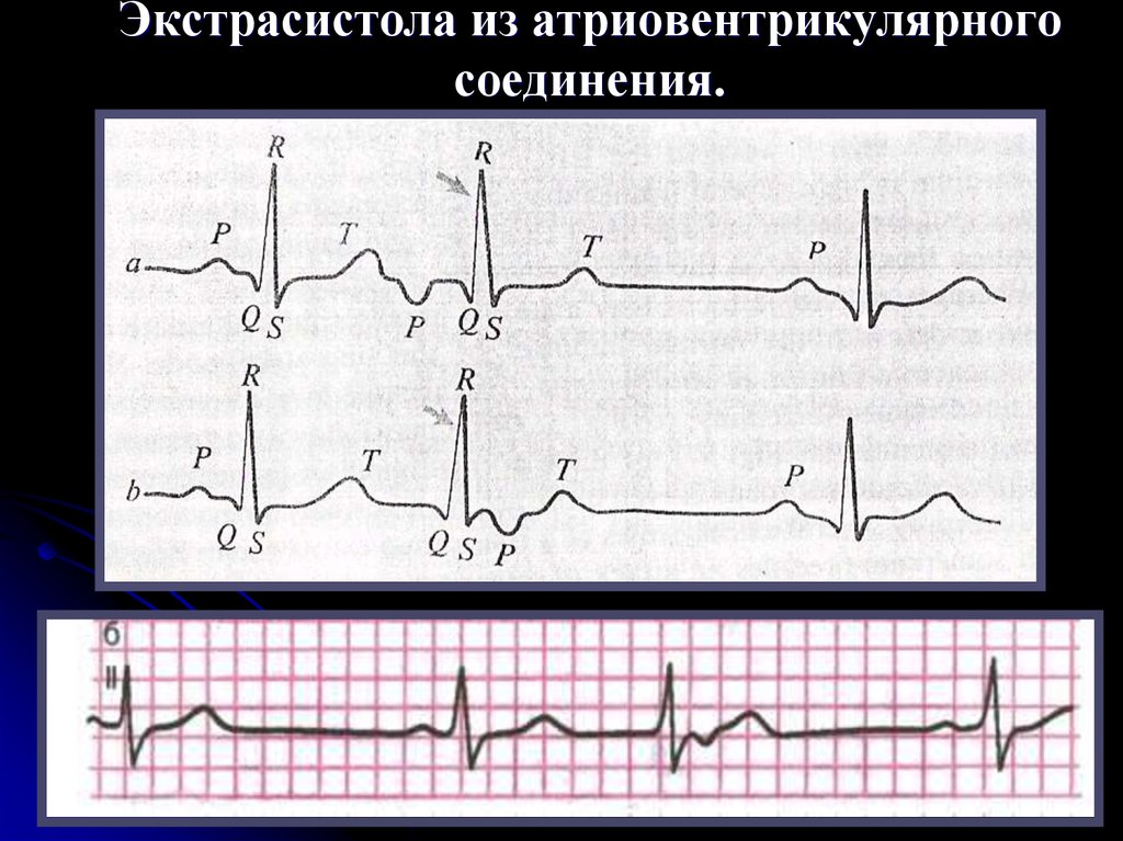 Экстрасистолы. Атриовентрикулярные экстрасистолы на ЭКГ. Атриовентрикулярная экстрасистолия на ЭКГ. ЭКГ при атриовентрикулярной экстрасистолии. Экстрасистолы из атриовентрикулярного соединения.