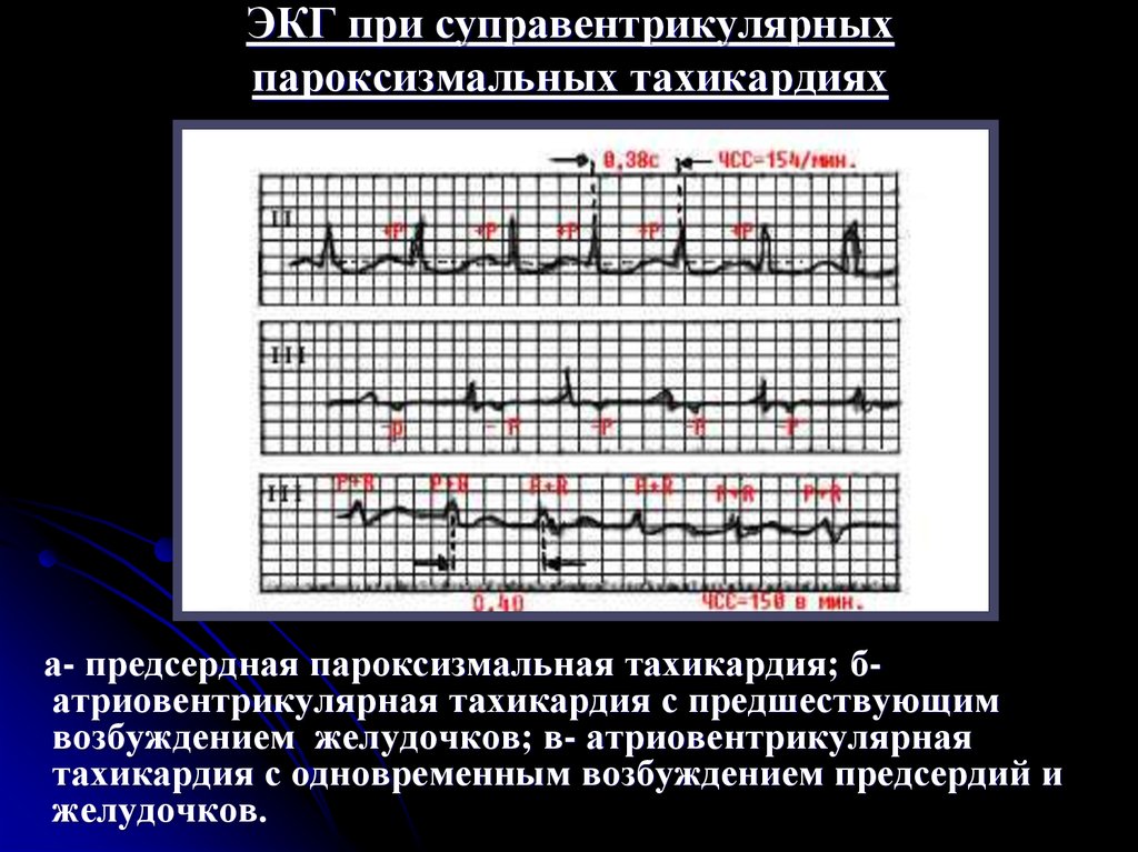 Экг картина при пароксизме суправентрикулярной тахикардии имеет вид