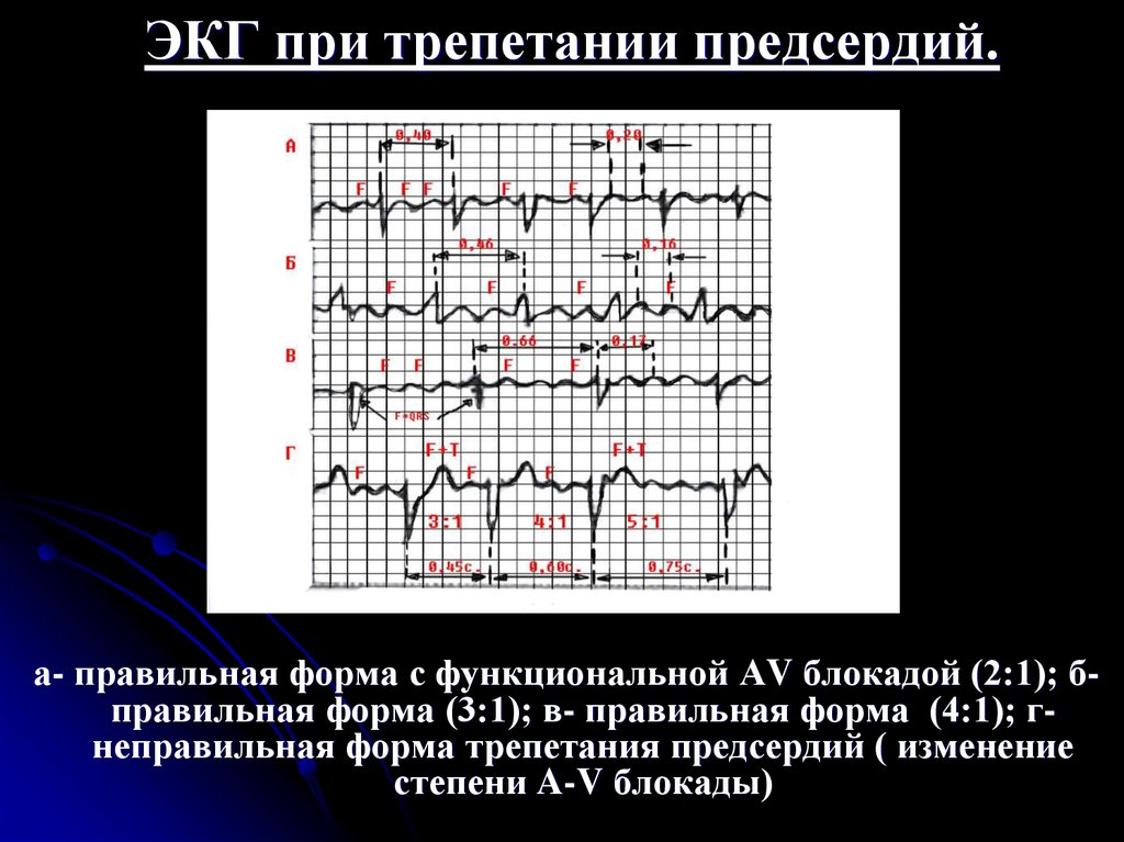 Экг предсердий. ЭКГ при трепетании предсердий правильная форма. Трепетание предсердий 1 к 1 на ЭКГ. Трепетание предсердий 2 к 1 на ЭКГ. Трепетания предсердий с блокадой 2:1 ЭКГ.