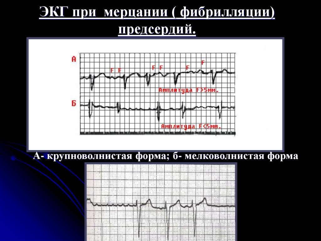 Фибрилляция на экг. Мерцательная аритмия тахисистолическая форма ЭКГ. Брадисистолическая форма мерцания предсердий на ЭКГ. Трепетание и фибрилляция предсердий на ЭКГ. ЭКГ-признаки фибрилляции (мерцания) предсердий.