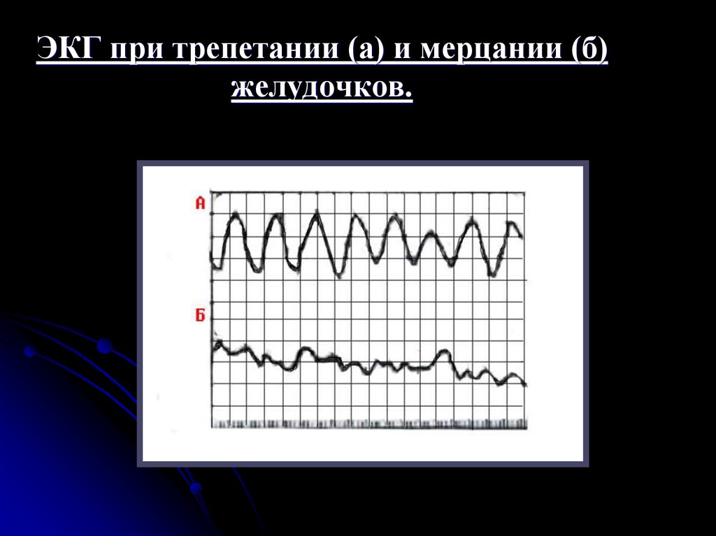 Фибрилляция желудочков на экг картинки