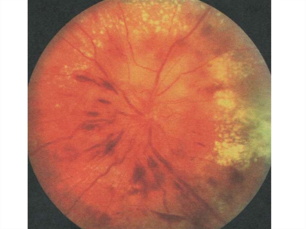 Заболевания сосудистой оболочки. Ретинопатия отслойка сетчатки. Отслойка сетчатки глазное дно. Почечная ретинопатия глазное дно. Диабетическая ангиопатия сетчатки.