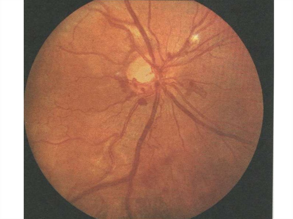Аномалия развития зрительного нерва