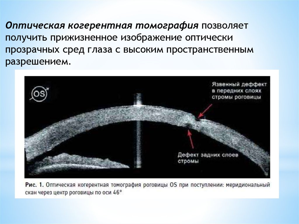 Когерентная томография. Оптическая когерентная томография роговицы. Оптическая когерентная томография переднего отрезка глаза. Противопоказания для оптической когерентной томографии.