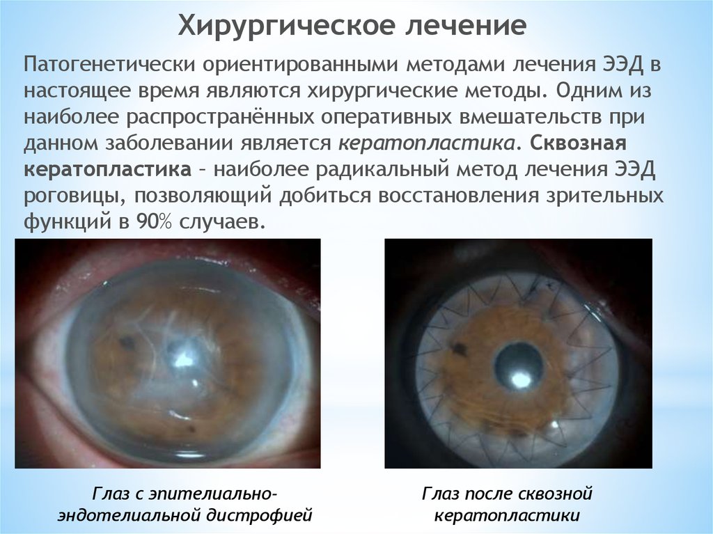 Мукоидоз дистрофия рисунок