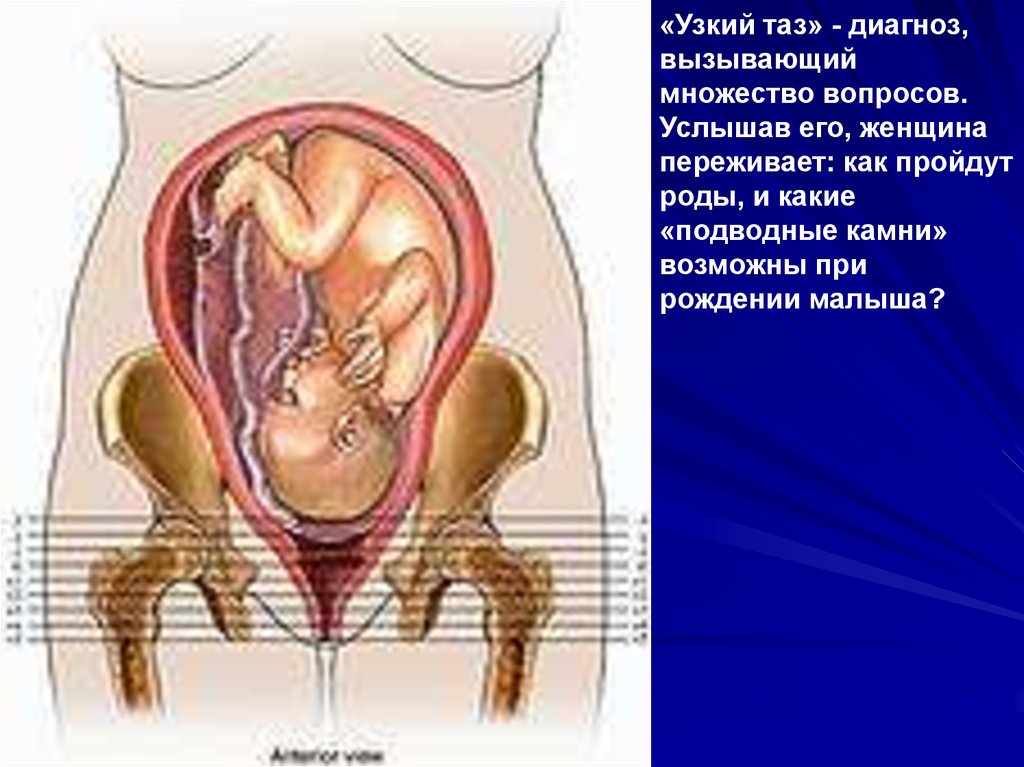 Расширение таза при беременности. Таз при родах расширяется. Строение таза у беременных. Узкий таз в современном акушерстве.