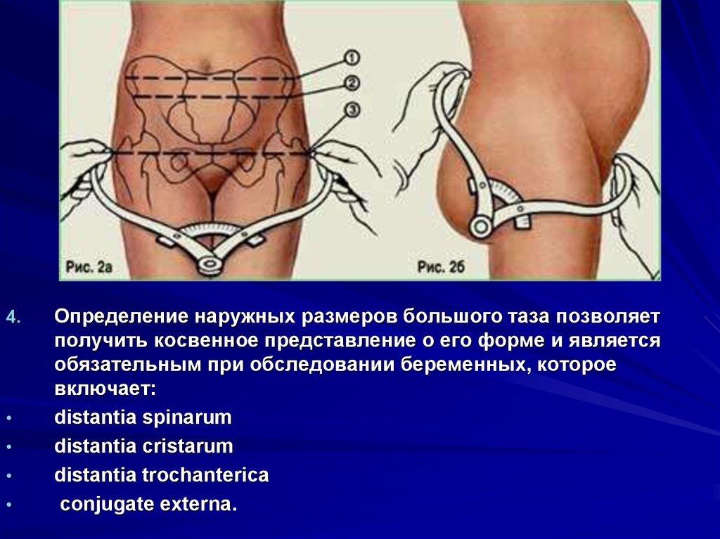 Размеры таза. Distantia spinarum в норме. Distantia cristarum. Измерение наружных размеров большого таза. Измерение наружных размеров большого таза алгоритм.