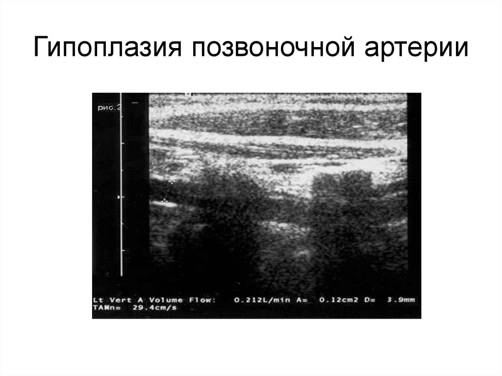 Гипоплазия сегмента v4 позвоночных артерий. Гипоплазия v4 позвоночной артерии. Гипоплазия позвоночной артерии на УЗИ. Гипоплазия v4 сегмента левой позвоночной артерии. Гипоплазия позвоночной артерии УЗДГ.