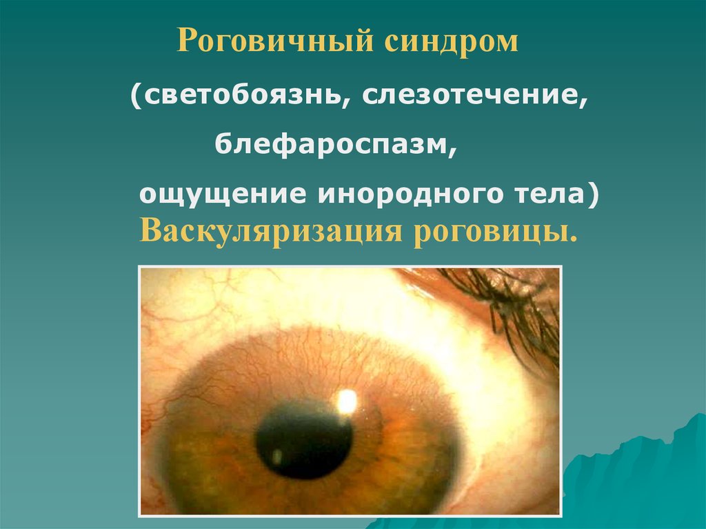 Ощущение инородного. Кератит васкуляризация. Неоваскуляризация роговицы.