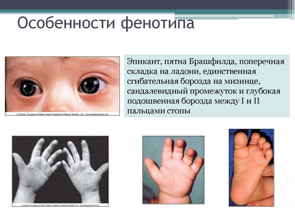 Фенотип ребенка с синдромом дауна. Синдром Дауна поперечная ладонная складка. Поперечная складка на ладони у новорожденного. Поперечная складка на ладони у Дауна. Обезьянья складка на ладони при болезни Дауна.
