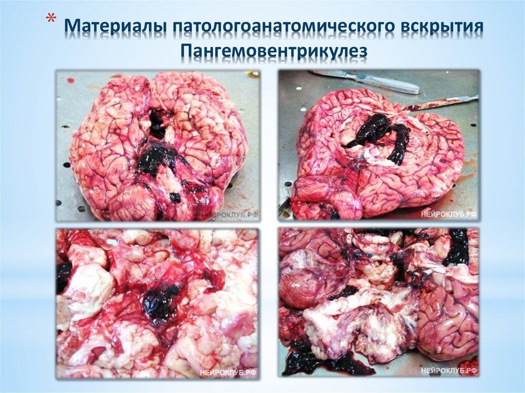 Материалы патологоанатомического вскрытия Пангемовентрикулез