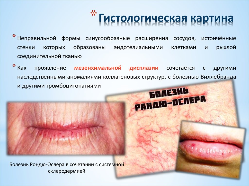 Болезнь Рандю-Ослера-Вебера (Наследственная геморрагическая ...