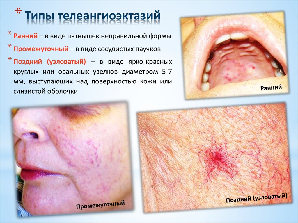 Типы телеангиоэктазий