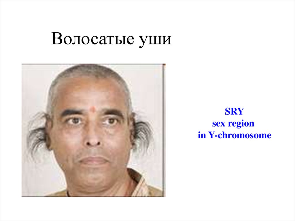 Наследование гипертрихоза. Гипертрихоз ушной раковины Тип наследования. Гипертрихоз края ушной раковины. Волосатость ушной раковины.