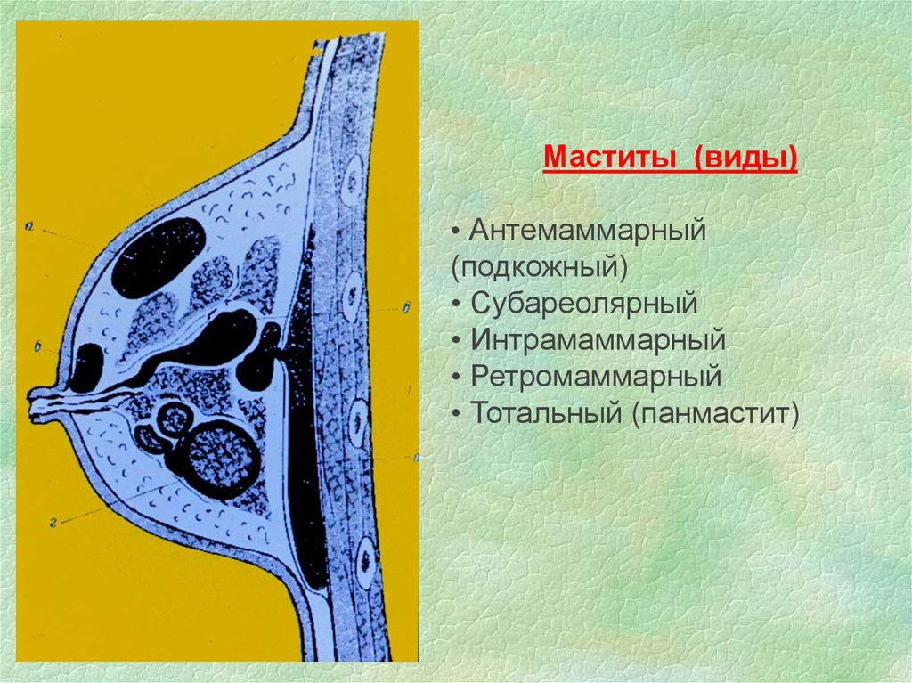 Мастит. Ретромаммарный мастит. Мастит классификация по локализации. Ретромаммарный Гнойный мастит. Гнойный мастит классификация.