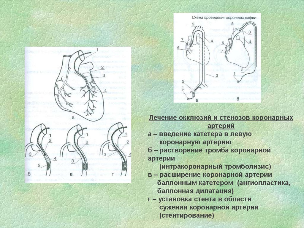 Коронарная окклюзия. Катетеризация коронарных артерий. Позиция окклюзии катетера это. Катетеризация левой и правой коронарных артерий.