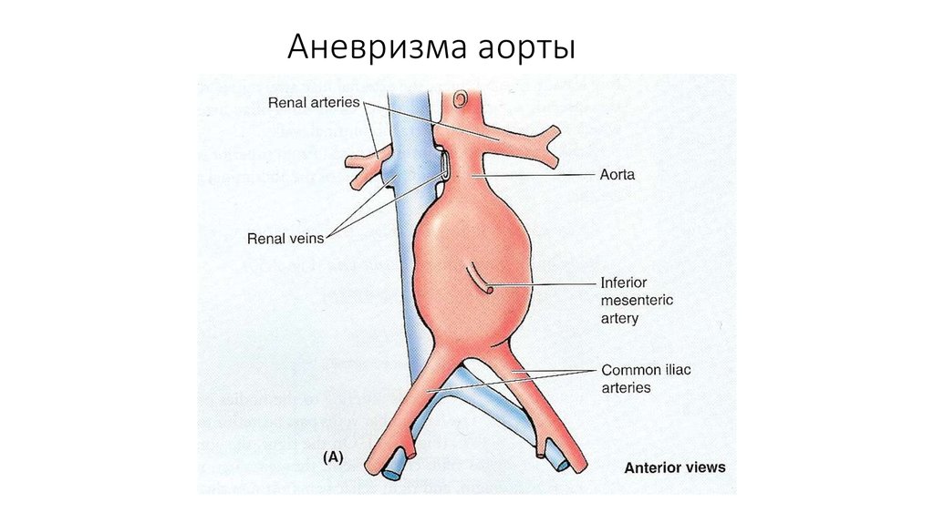 Аневризма синуса. Аневризма корня и восходящего отдела аорты. Аневризма Вальсальвы отдела аорты. Аневризма восходящего отдела аорты клинические рекомендации. Аневризма синусов Вальсальвы критерии.