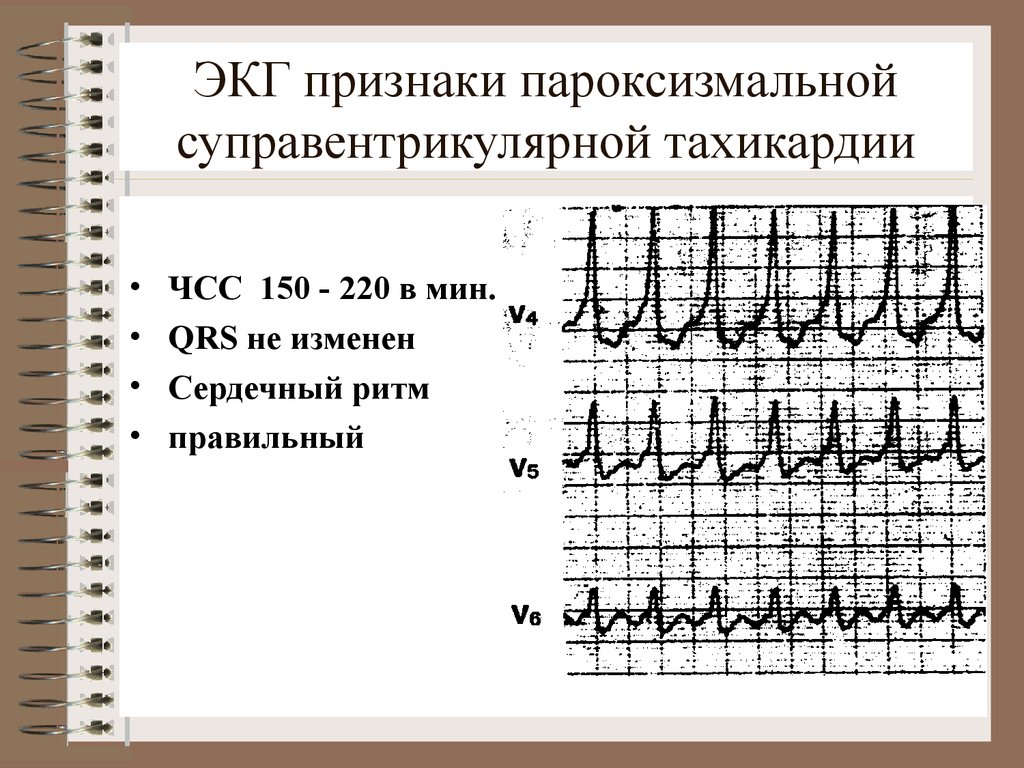 Экг при тахикардии фото