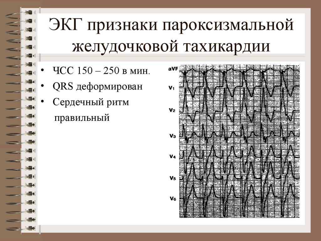 Желудочковая тахикардия экг фото