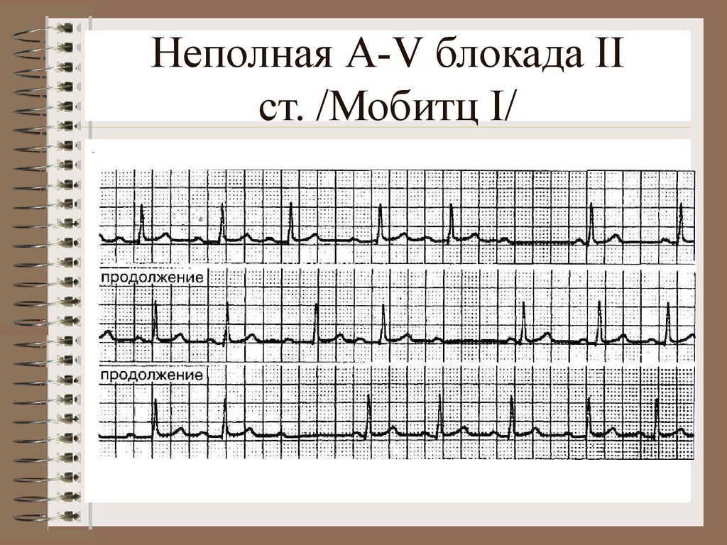 Ав блокада 2. АВ блокада Мобитц 1 ритм. АВ блокада 2 степени Мобитц 3. А-В блокада 2ст Мобитц 2. Неполная блокада.