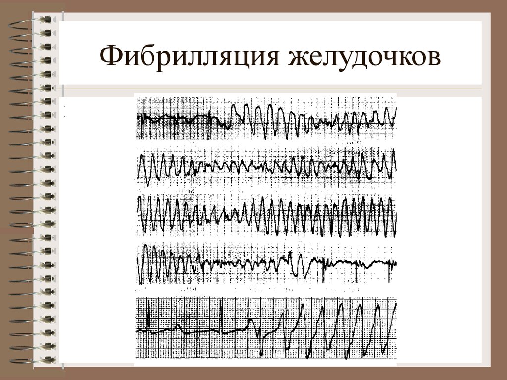 Фибрилляция желудочков фото