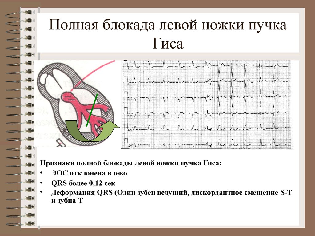 Блокада левого пучка гиса. Блокада левой ножки пучка Гиса. Полная блокада левого пучка Гиса. Критерии полной блокады левой ножки пучка Гиса. Полная блокада левая ножки пучка Гиса.