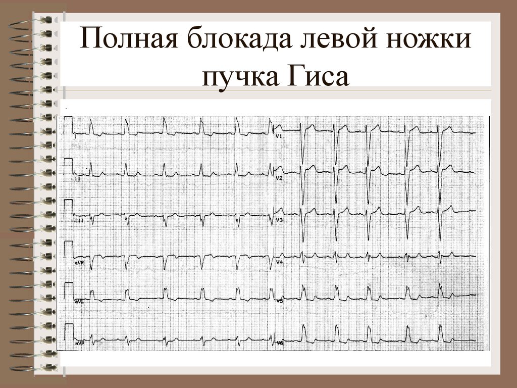 Блокада гиса на экг. Полная блокада левой ножки пучка Гиса на ЭКГ. Блокада левой ножки Гиса на ЭКГ. ЭКГ при полной блокаде левой ножки пучка Гиса. ЭКГ при блокаде ЛНПГ.