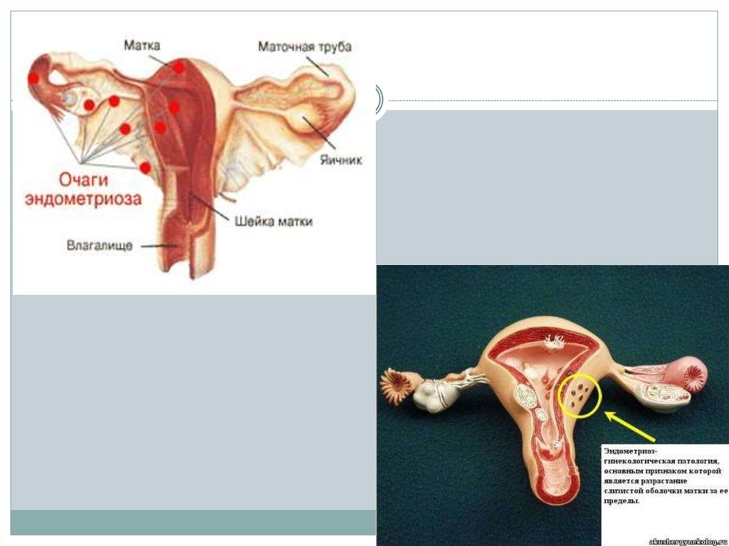 Endometriosis dolor después de la regla