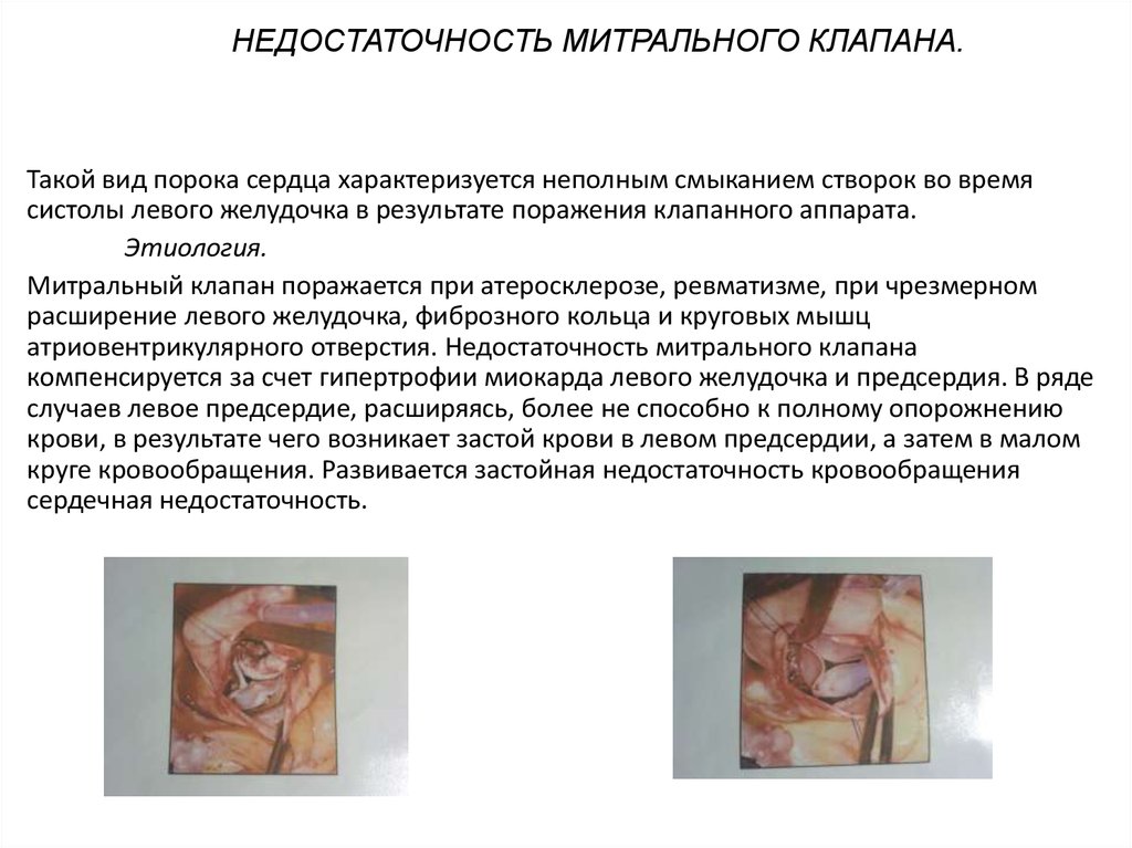 Недостаточность митрального клапана.