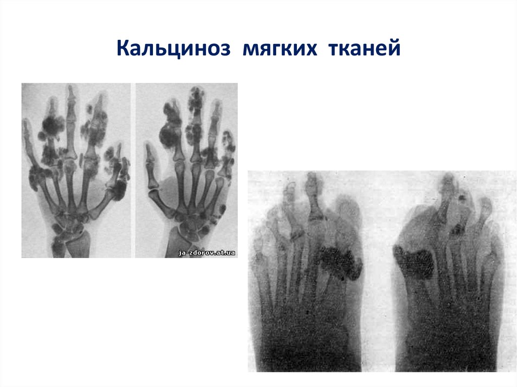 Кальцинаты на коже фото