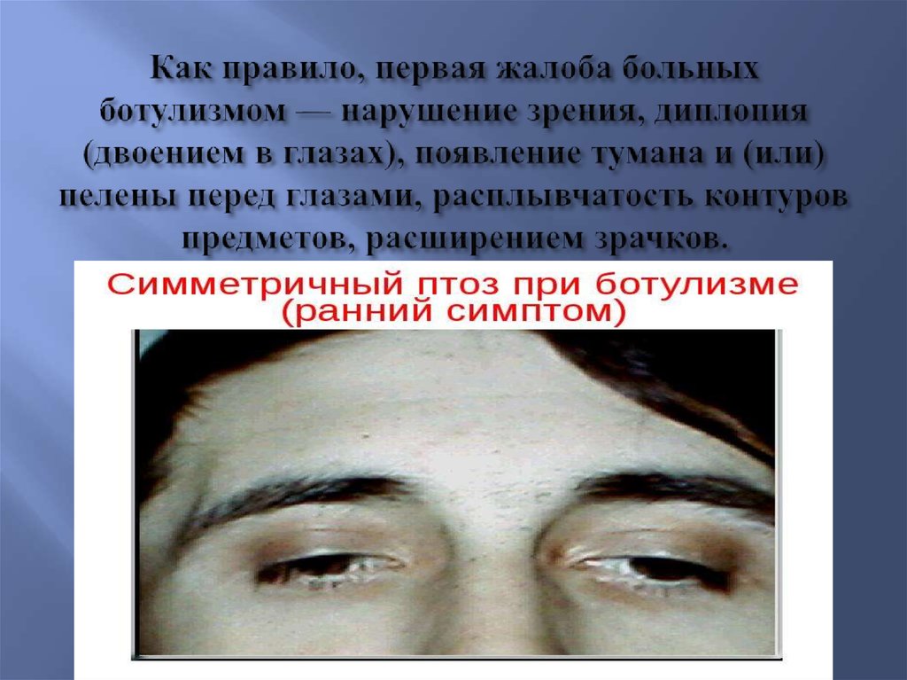 Как правило, первая жалоба больных ботулизмом — нарушение зрения, диплопия (двоением в глазах), появление тумана и (или) пелены