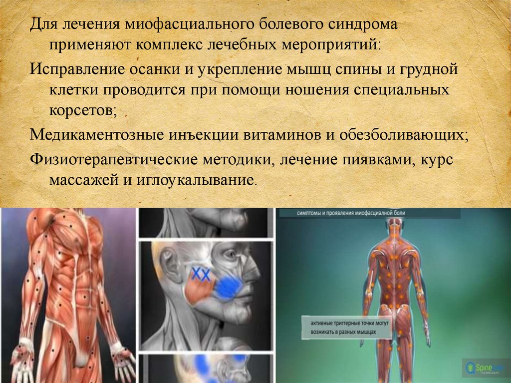 Миофасциальный болевой синдром. Симптомы миофасциального синдрома. Лечение миофасциального болевого синдрома. Миофасциальный болевой синдром грудной мышцы.