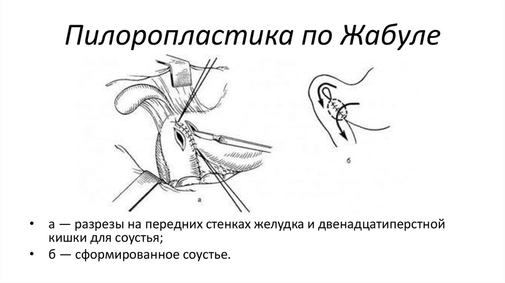 Пилоропластика по финнею схема