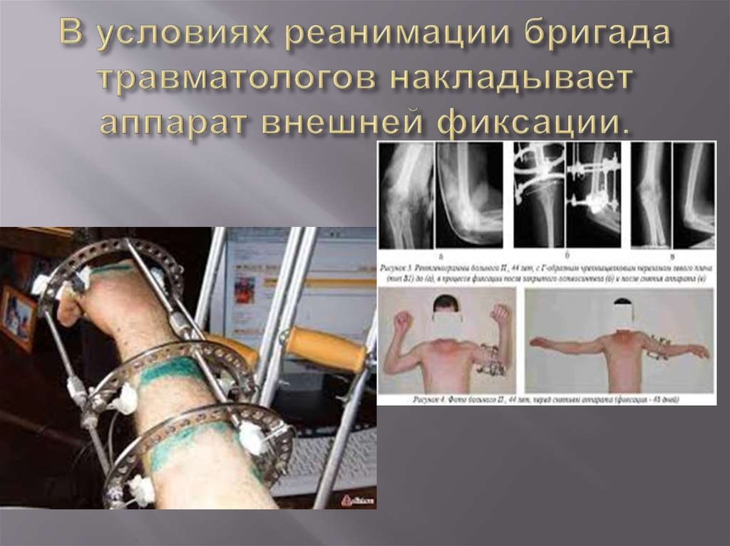 Особенности интенсивной терапии и анестезии при травме верхних ...