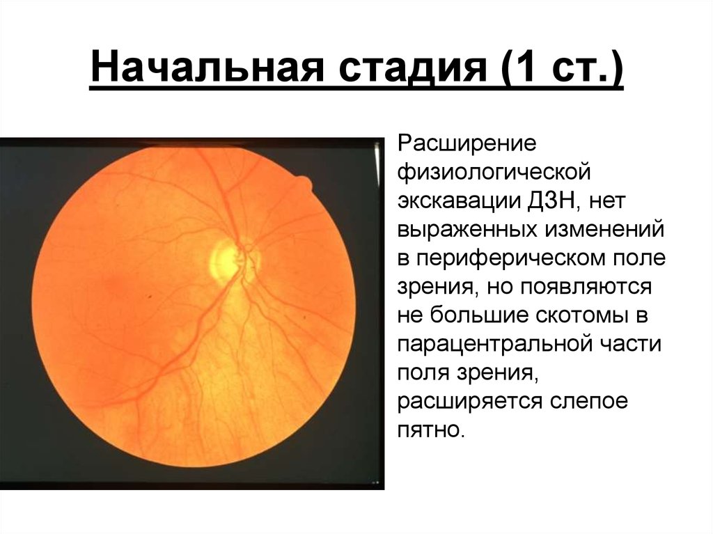 Диск глазного нерва. Застойный диск зрительного нерва стадии. Физиологическая экскавация ДЗН. Экскавация глазного дна.