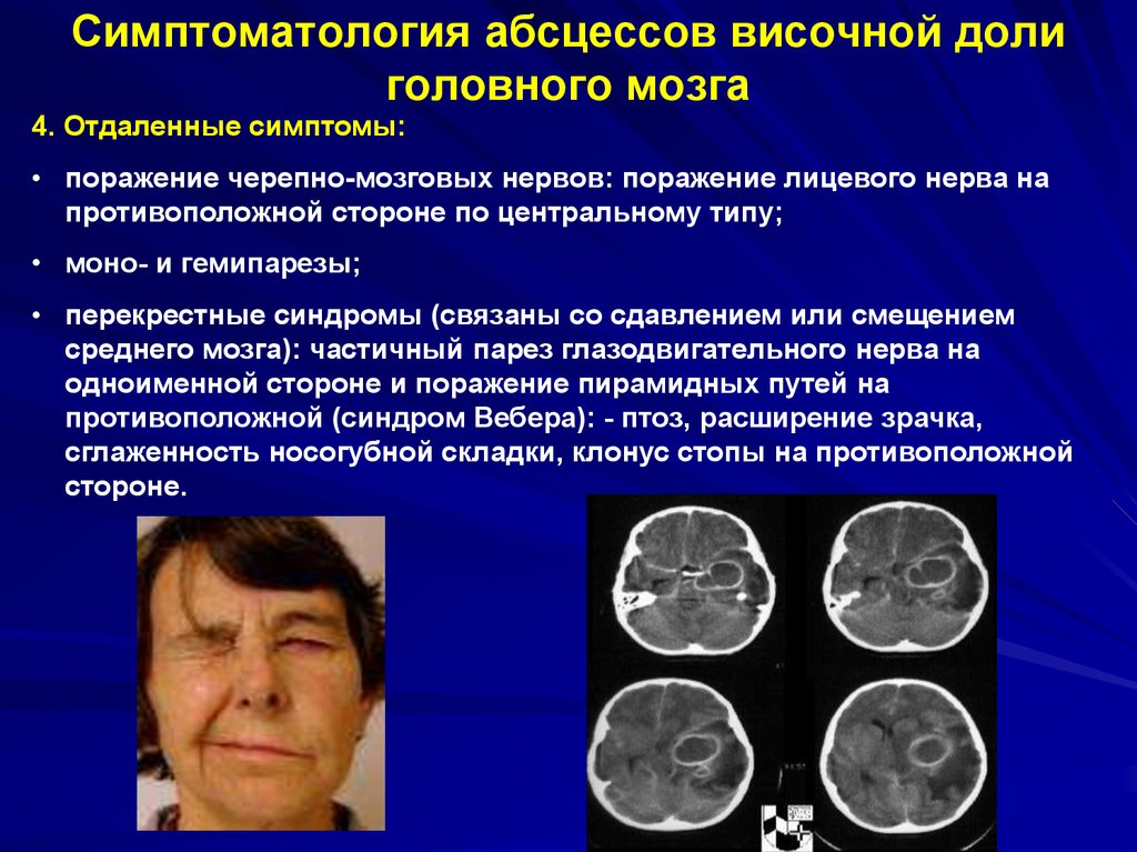 Симптоматология абсцессов височной доли головного мозга