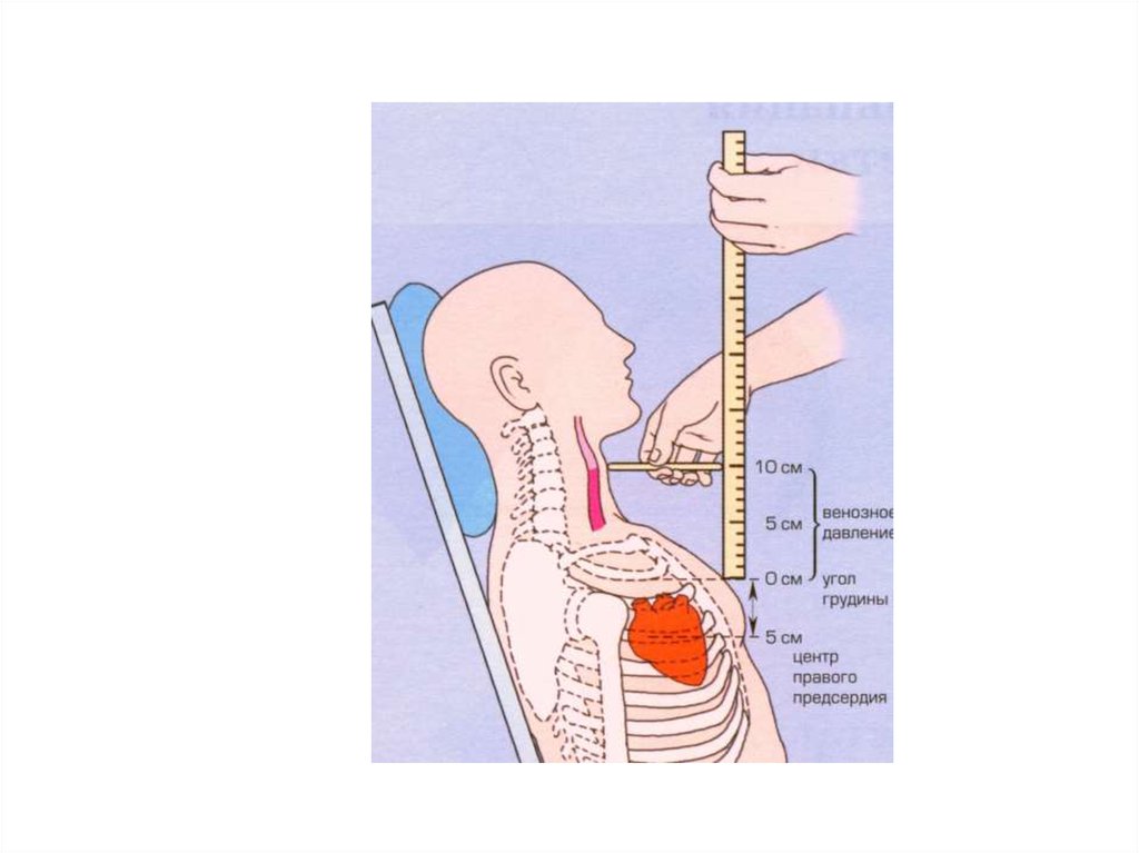 Венозное давление. Измерение центрального венозного давления линейкой. Аппарат Вальдмана. Флеботонометр Вальдмана. Измерение центрального венозного давления алгоритм.
