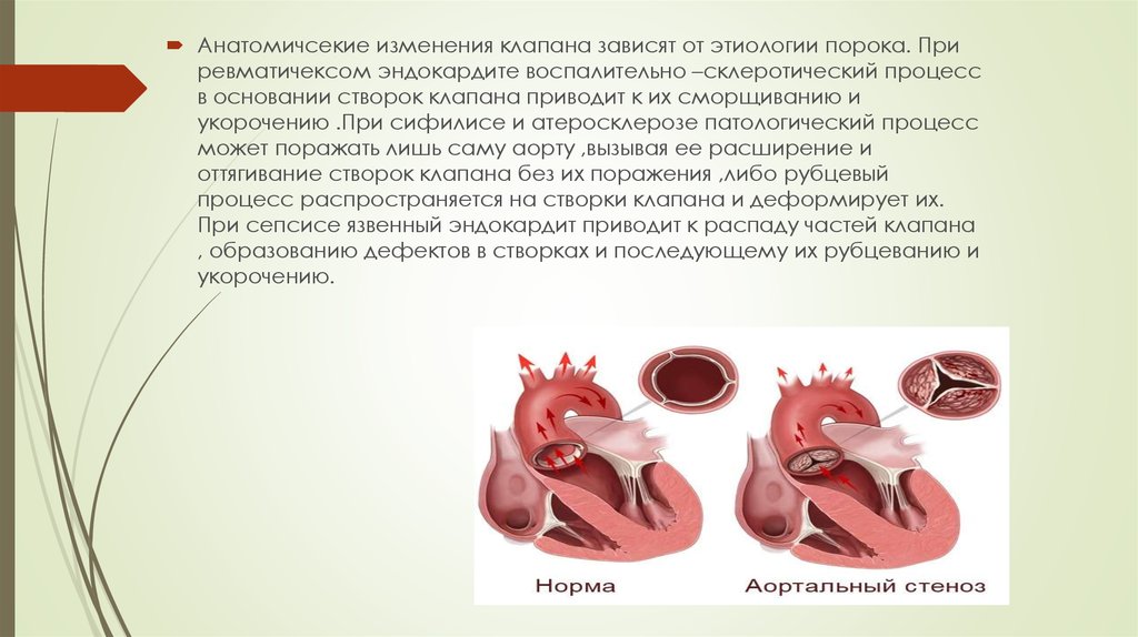 Недостаточность аортального клапана это