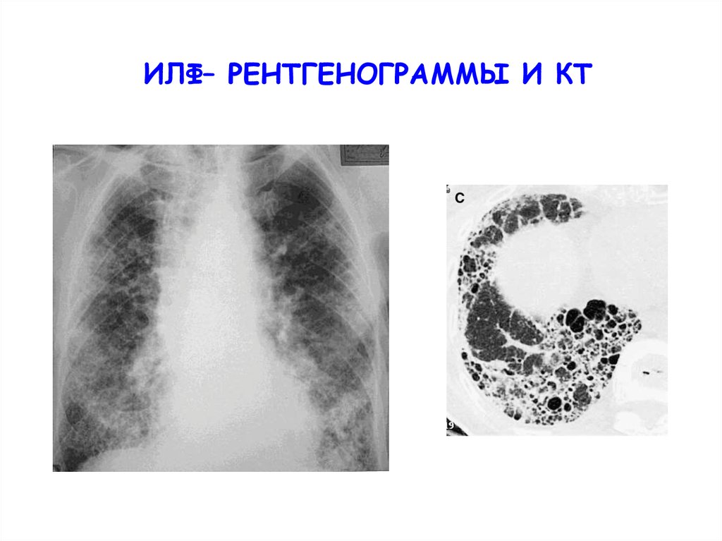 Идиопатический легочный фиброз тесты. Идиопатический легочный фиброз. Идиопатический легочный фиброз рентгенограмма. Идиопатический легочный фиброз кт. Диффузные интерстициальные заболевания легких.