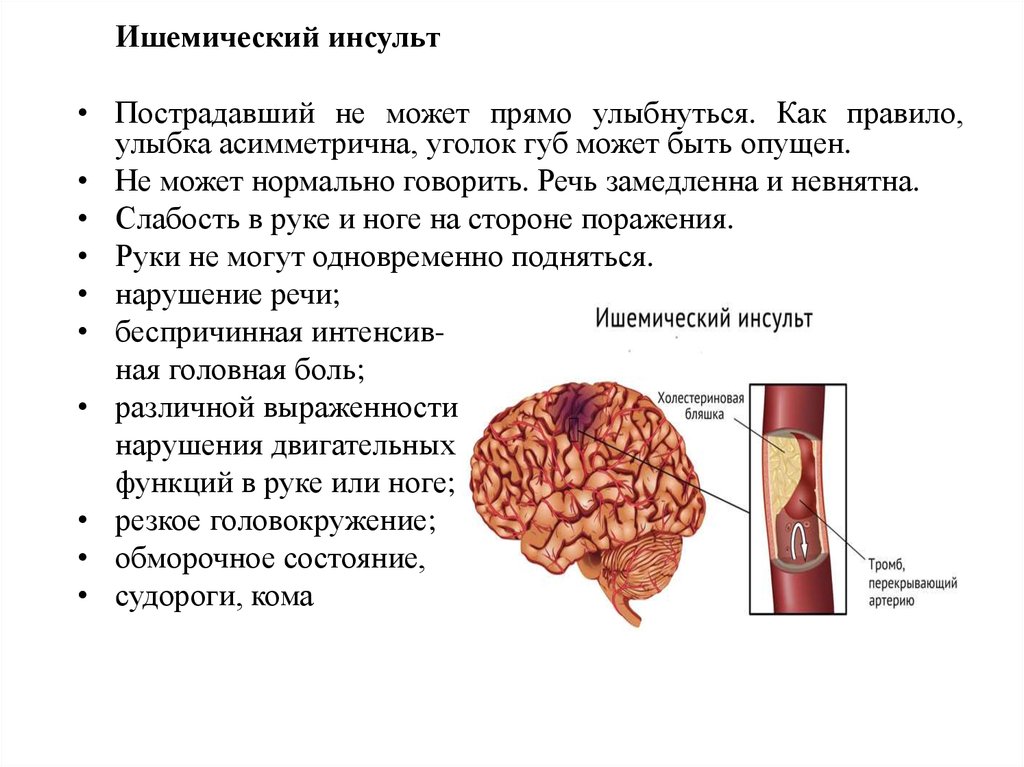 Правосторонний ишемический инсульт головного мозга. Ишемический инсульт симптомы. Начало ишемического инсульта.