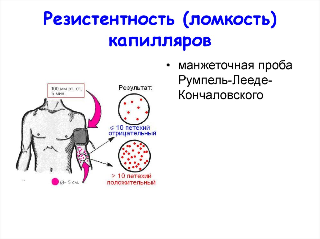 1 резистентность. Проба на резистентность капилляров. Манжеточная проба Кончаловского-румпеля-Лееде. Пробы на механическую устойчивость капилляров. Положительная манжеточная проба.