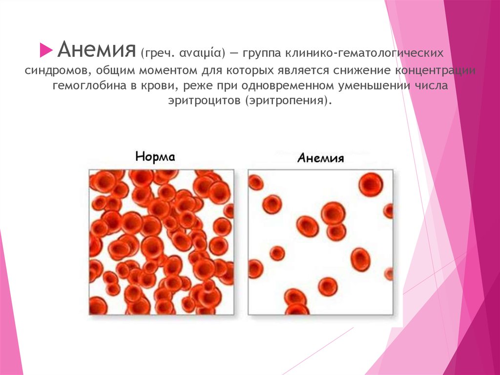 Анемия и эритроциты в крови. Снижение гемоглабинав кров. Анемия эритроциты. Снижение эритроцитов и гемоглобина в крови.