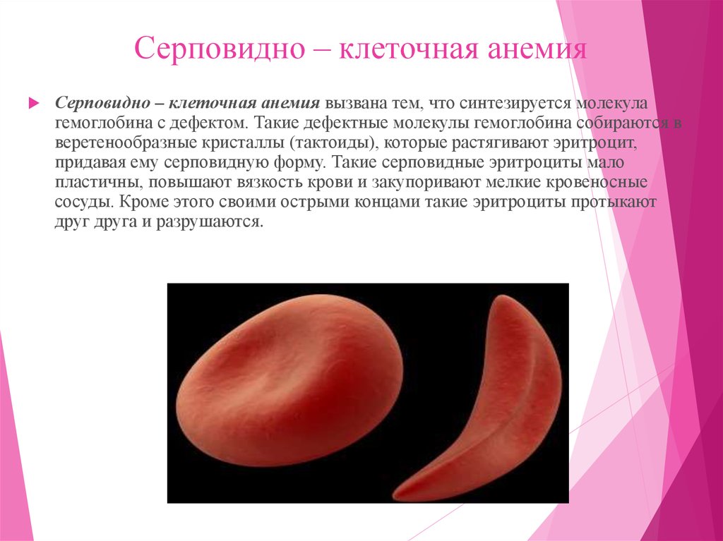 Серповидноклеточная анемия какая. Серповидно клетосная анемия. Серповидная клеточная анемия симптомы. Серповидно- клеточные аннмии. Серповидная анемия эритроциты.