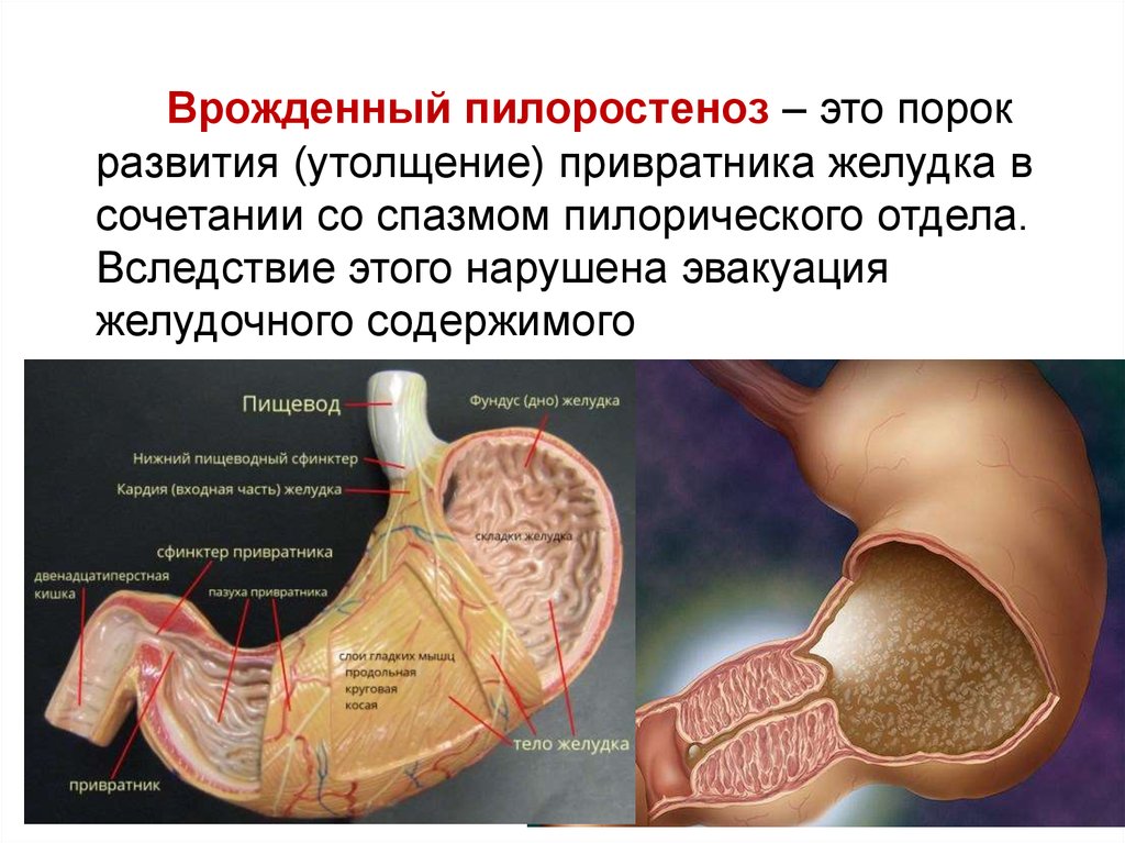 Симптом перилобулярного утолщения на компьютерных томограммах визуализируется как